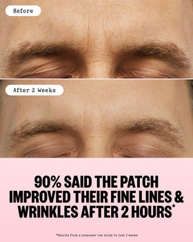 Application des patches microneedling PEACE OUT sur la peau