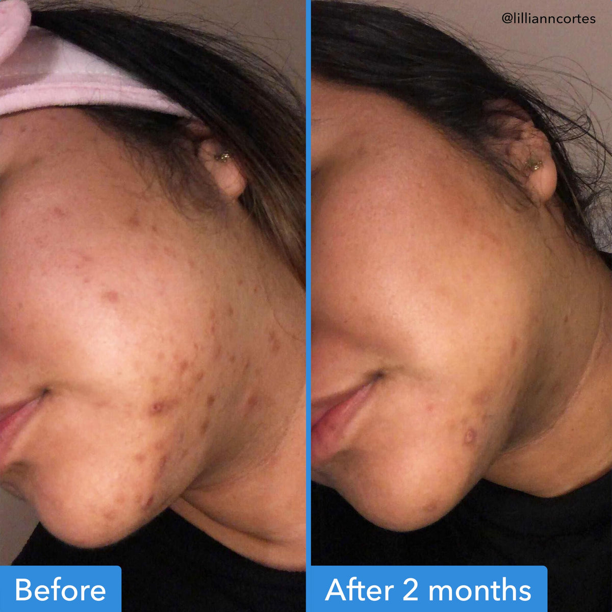 Application du Sérum Correcteur de Teint Good Molecules sur la peau