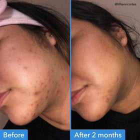 Application du Sérum Correcteur de Teint Good Molecules sur la peau
