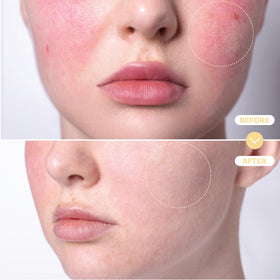Application du spray d'acide hypochloreux sur le visage