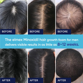 Artimore mousse de Minoxidil 5%, utilisation sur barbe