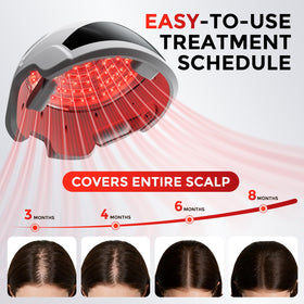 Casque OVEKPA avec lampes laser disposées en matrice pour une couverture uniforme