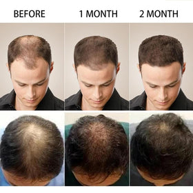 Crème MQN 5% Minoxidil avec des ingrédients naturels en arrière-plan