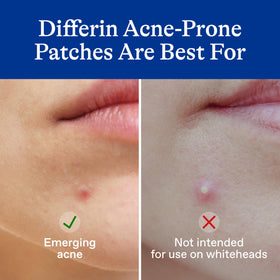 Détails des patches anti-acné Differin