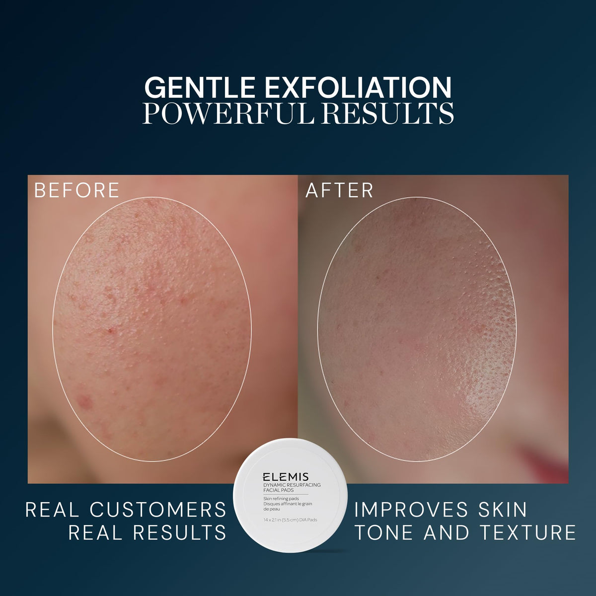 ELEMIS Pads Exfoliants, application sur le visage en mouvement circulaire