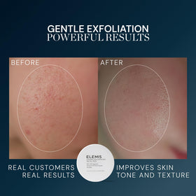 ELEMIS Pads Exfoliants, application sur le visage en mouvement circulaire