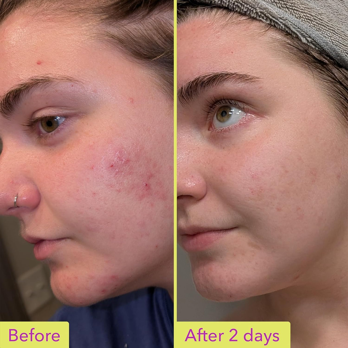 Good Molecules Traitement à l'Acide Azélaïque 10% 30 ml, application sur la main