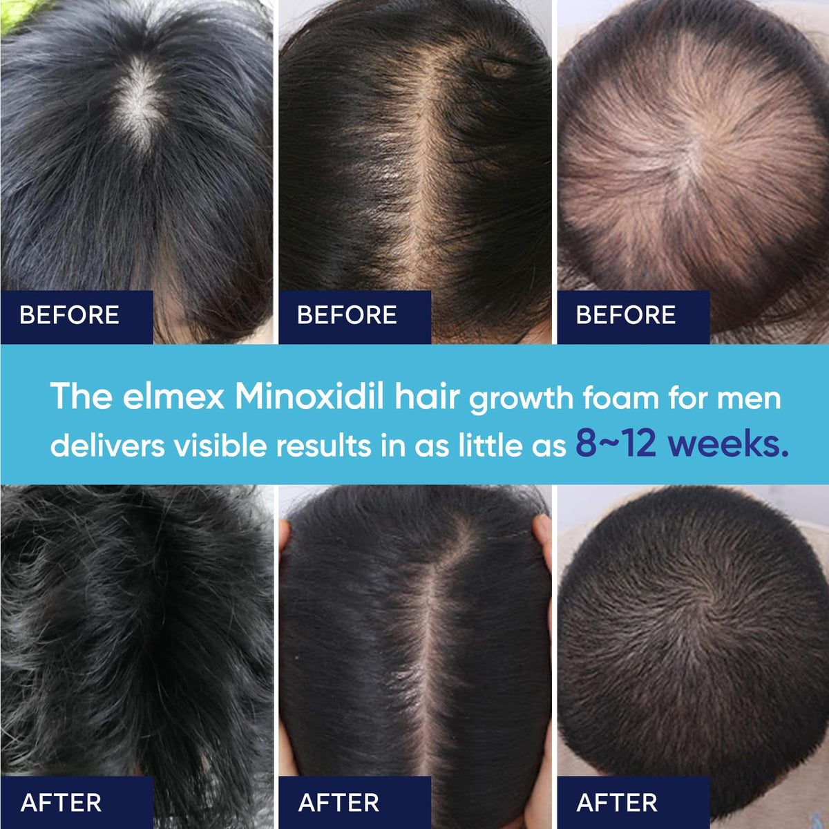 Mousse de Minoxidil 5% Artimore avec biotine et huile de ricin