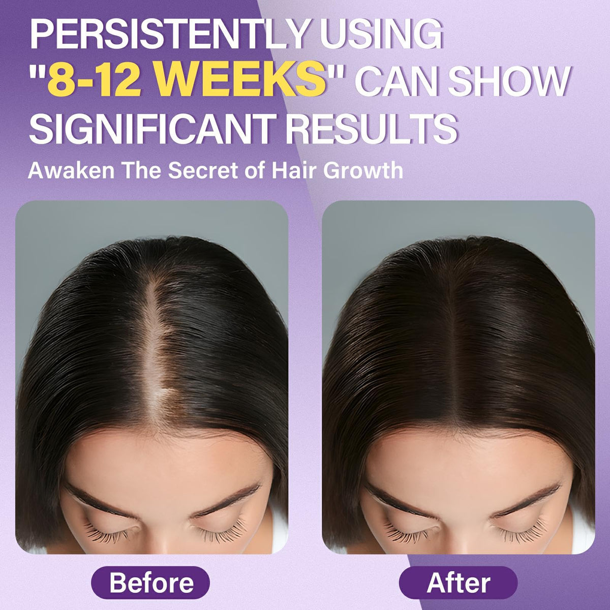 Mousse de Minoxidil 5% Greoay, application sur le cuir chevelu