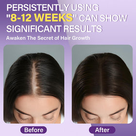 Mousse de Minoxidil 5% Greoay, application sur le cuir chevelu