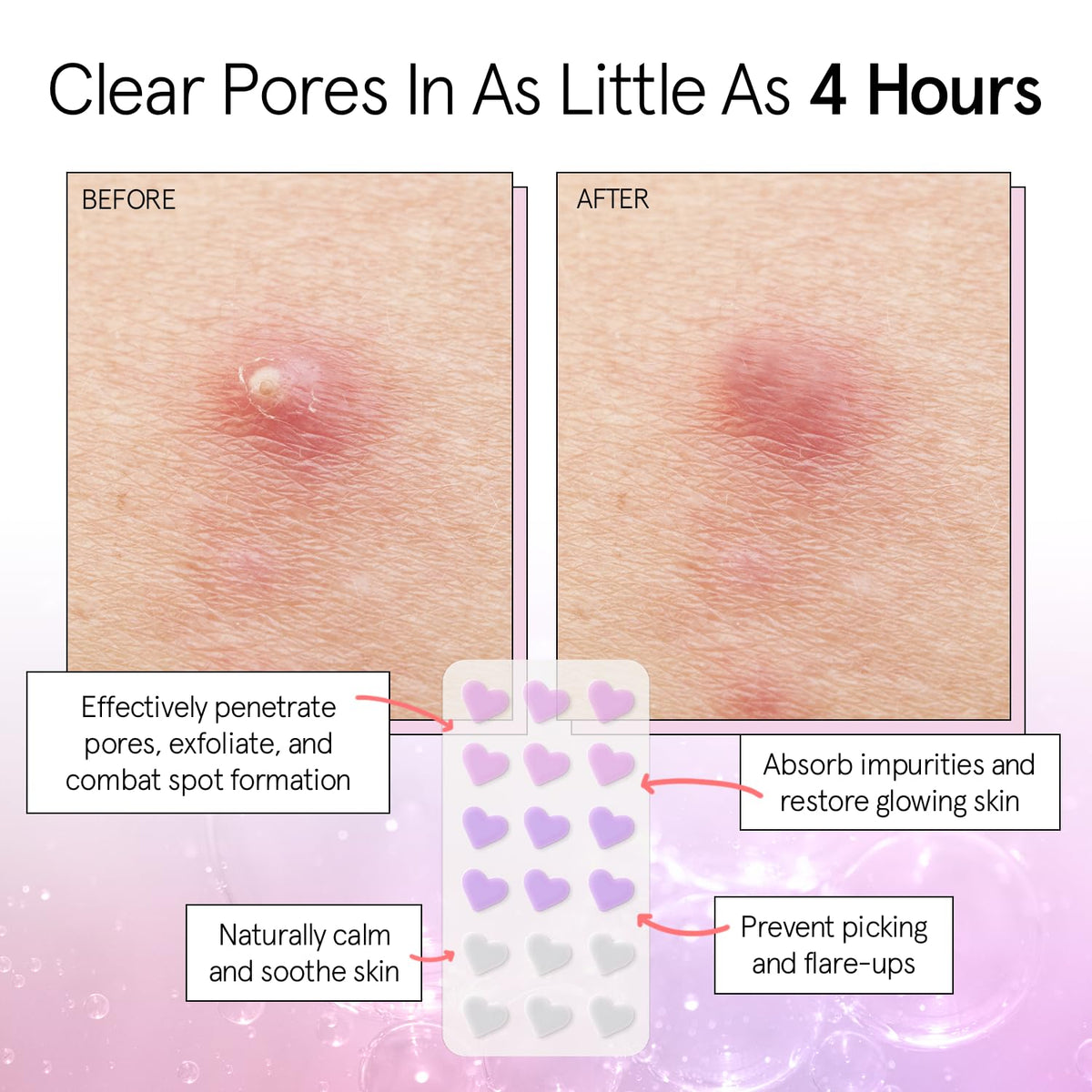 Patch anti-imperfection en forme de cœur violet