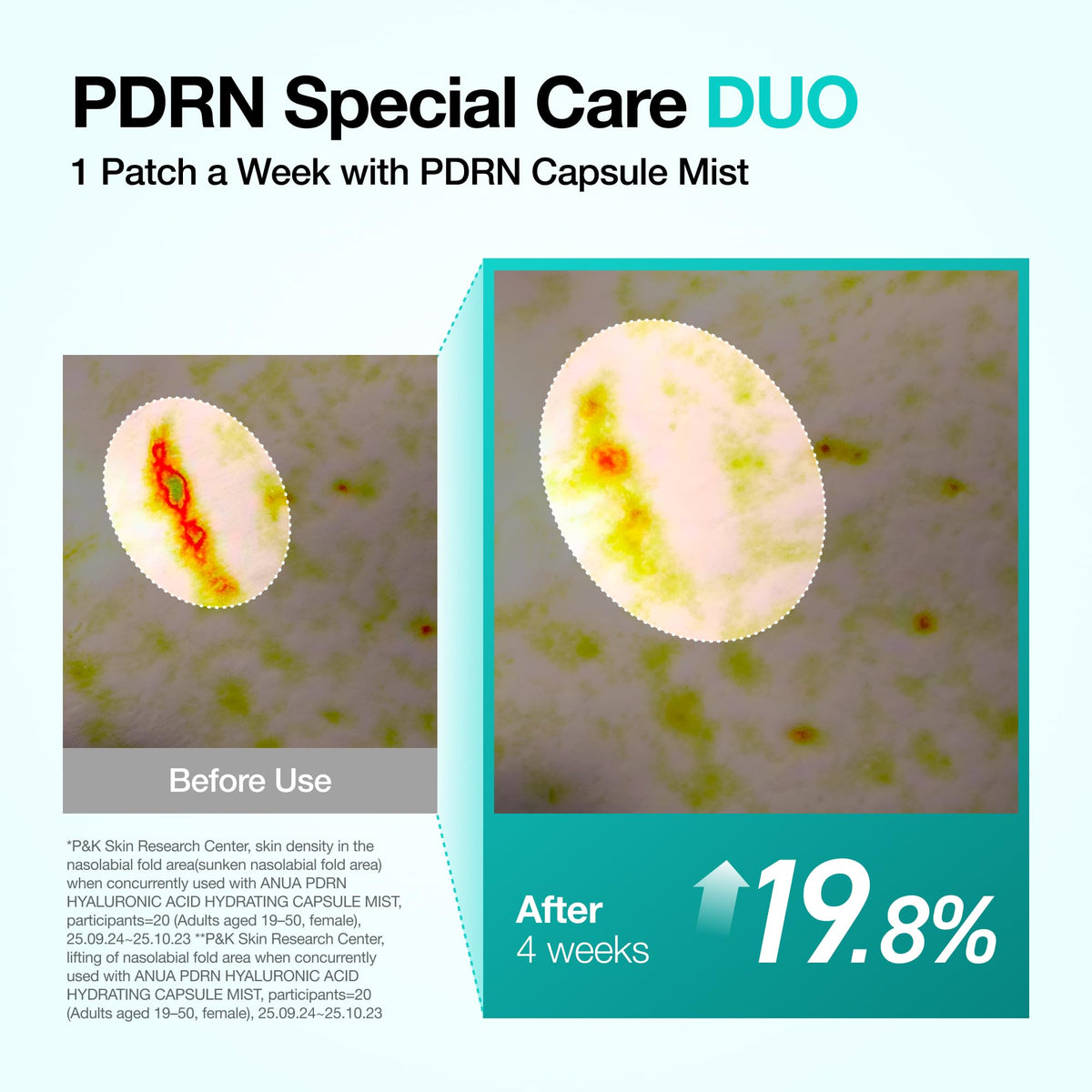 Patch ANUA PDRN appliqué sur la zone des sourires