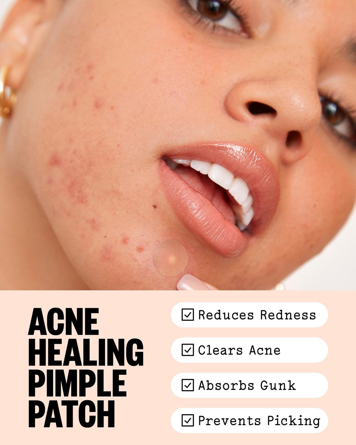 Patch hydrocolloïde PEACE OUT sur une imperfection du visage