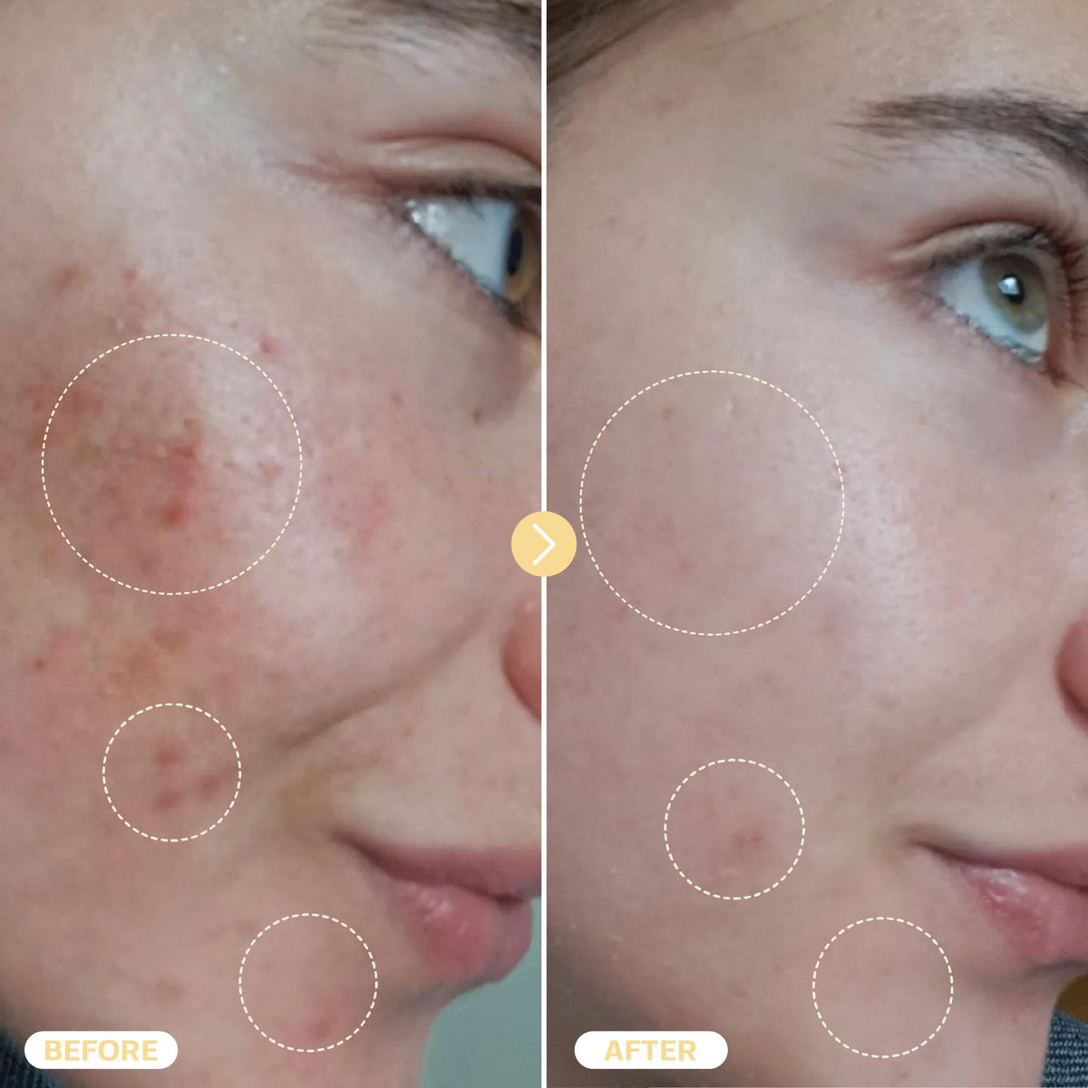 Spray d'acide hypochloreux en usage quotidien pour la peau