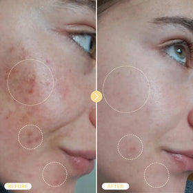 Spray d'acide hypochloreux en usage quotidien pour la peau