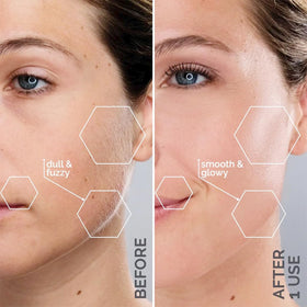 Système de Dermaplaning Sonicsmooth Pro+ en utilisation