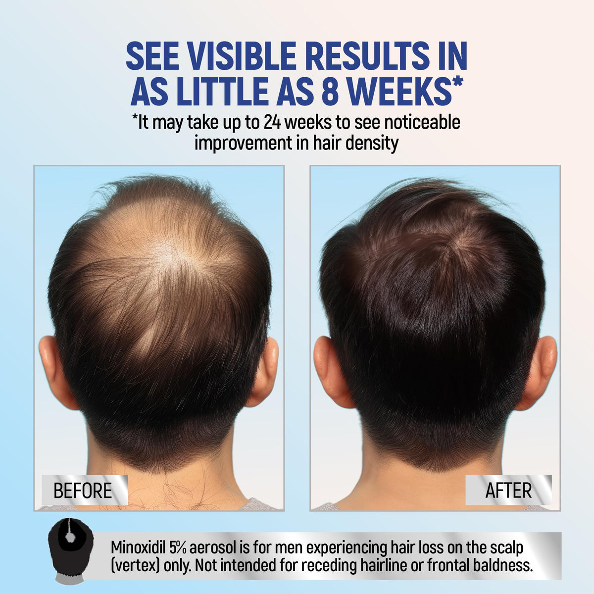 TARO Minoxidil 5% Mousse Topique application sur le cuir chevelu