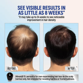 TARO Minoxidil 5% Mousse Topique application sur le cuir chevelu