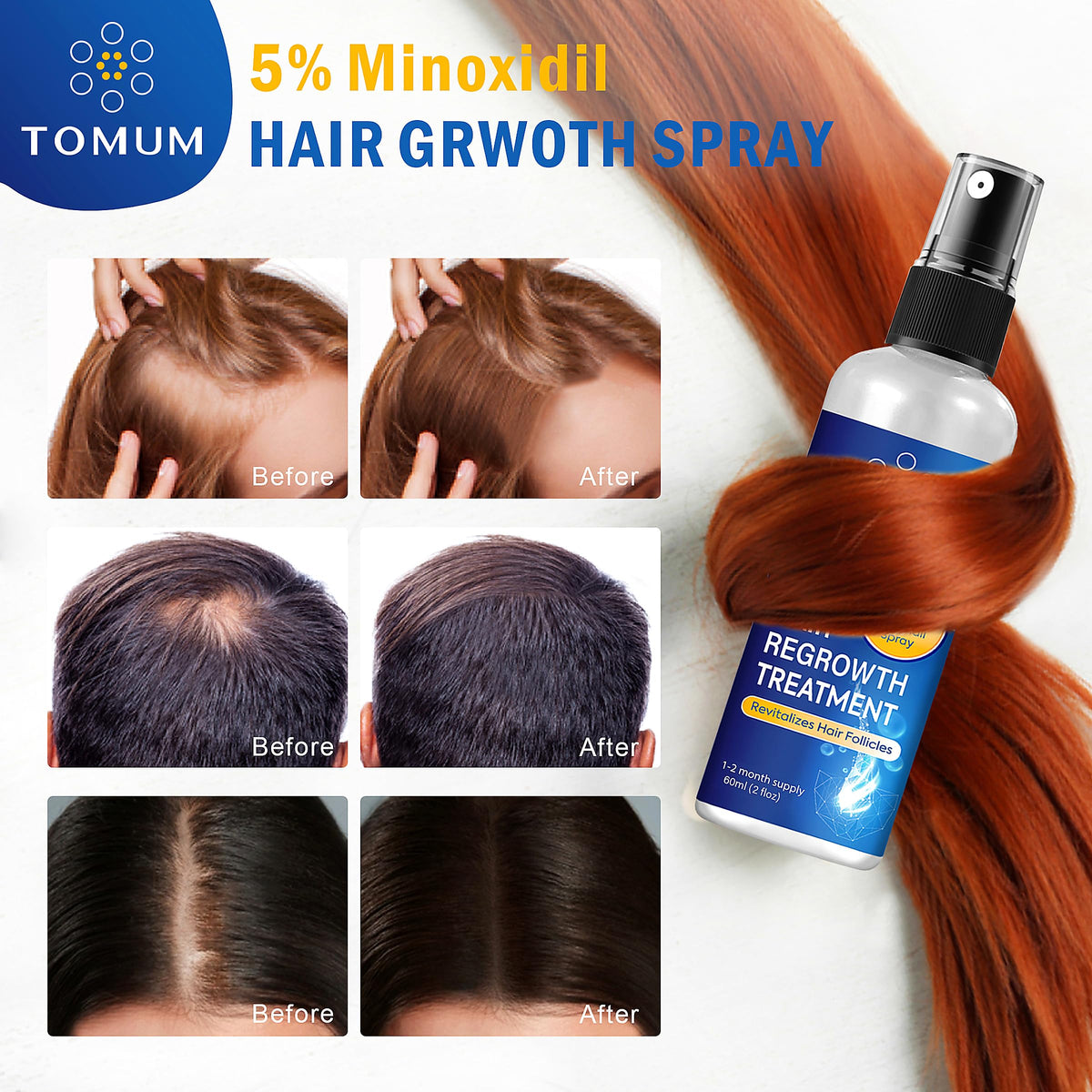 TOMUM Spray Capillaire 5% Minoxidil avec instructions d'utilisation