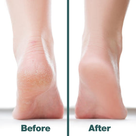 Utilisation de la lime à pied Probelle sur des talons fendus